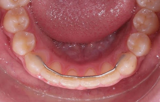 Pourquoi la contention est une phase clé du traitement ortho-chirurgical ?