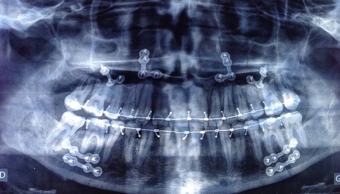Faut-il retirer les plaques d’ostéosynthèse après la chirurgie maxillo-faciale ?